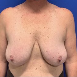 Breast Lift Before & After Patient #2970
