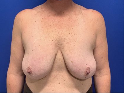 Breast Lift Before & After Patient #2970