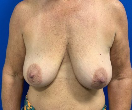 Breast Lift Before & After Patient #2974