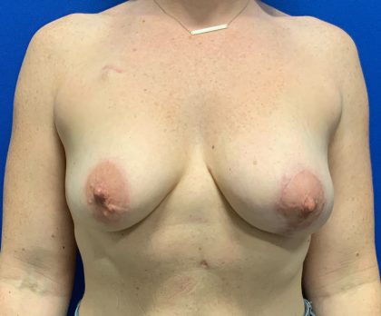 Breast Lift Before & After Patient #2968