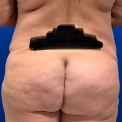 Liposuction Before & After Patient #2977