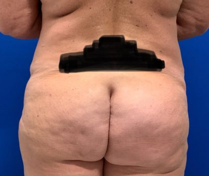 Liposuction Before & After Patient #2977