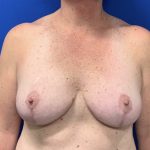 Breast Lift Before & After Patient #2970