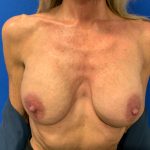 Breast Augmentation Before & After Patient #2975