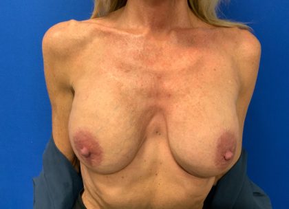 Breast Augmentation Before & After Patient #2975