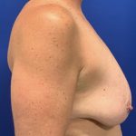 Breast Lift Before & After Patient #2970