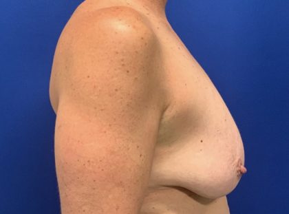 Breast Lift Before & After Patient #2970