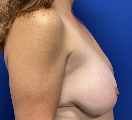 Breast Lift Before & After Patient #2971