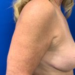 Breast Lift Before & After Patient #2974