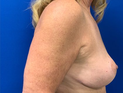 Breast Lift Before & After Patient #2974