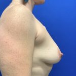 Breast Lift Before & After Patient #2968