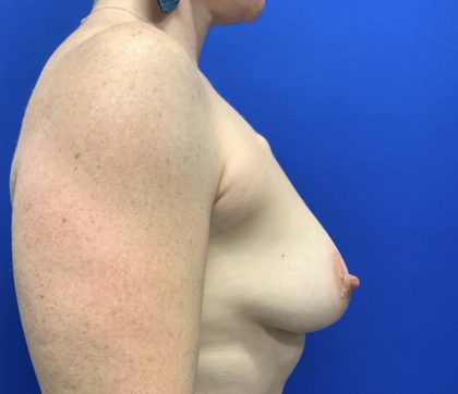Breast Lift Before & After Patient #2968