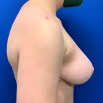 Breast Reduction Before & After Patient #2967