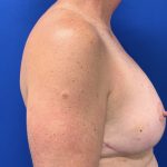 Breast Lift Before & After Patient #2970