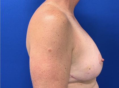 Breast Lift Before & After Patient #2970