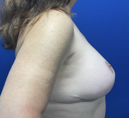 Breast Lift Before & After Patient #2971