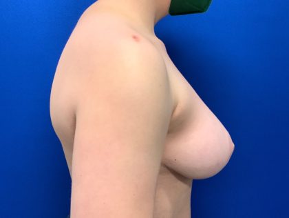 Breast Reduction Before & After Patient #2967