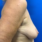 Breast Lift Before & After Patient #2974