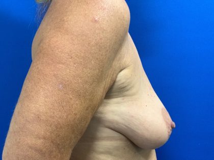 Breast Lift Before & After Patient #2974