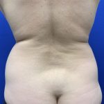 Liposuction Before & After Patient #3059