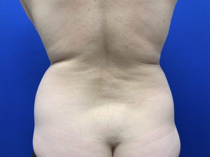 Liposuction Before & After Patient #3059