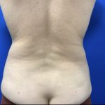 Liposuction Before & After Patient #3059