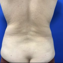 Liposuction Before & After Patient #3059