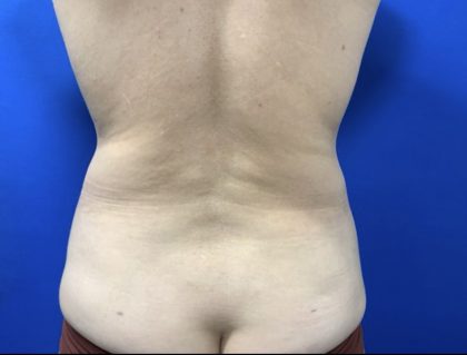 Liposuction Before & After Patient #3059