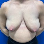 Breast Lift Before & After Patient #3079