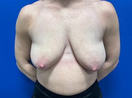 Breast Lift Before & After Patient #3079
