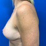 Breast Lift Before & After Patient #3079