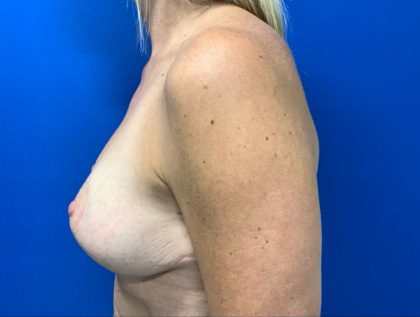 Breast Lift Before & After Patient #3079