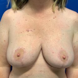 Breast Reduction With Galaflex Before & After Patient #3142