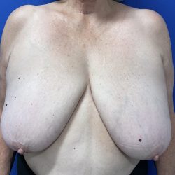 Breast Reduction Before & After Patient #3119