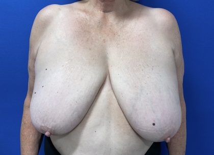 Breast Reduction Before & After Patient #3119