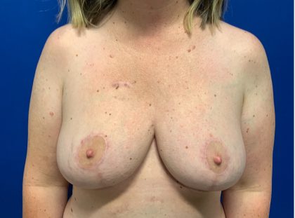 Breast Reduction With Galaflex Before & After Patient #3137