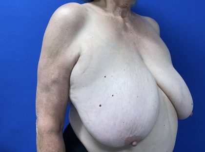 Breast Reduction Before & After Patient #3119